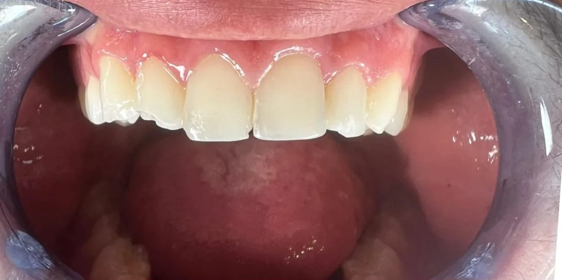Before treatment: a patient's upper front teeth with the lips held back