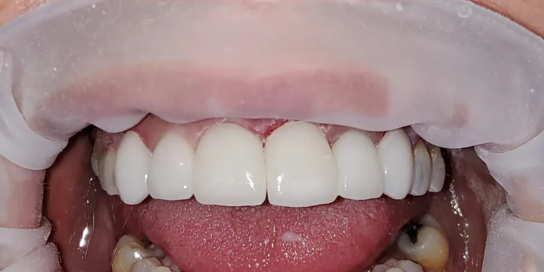 After treatment: a patient's upper and lower front teeth
