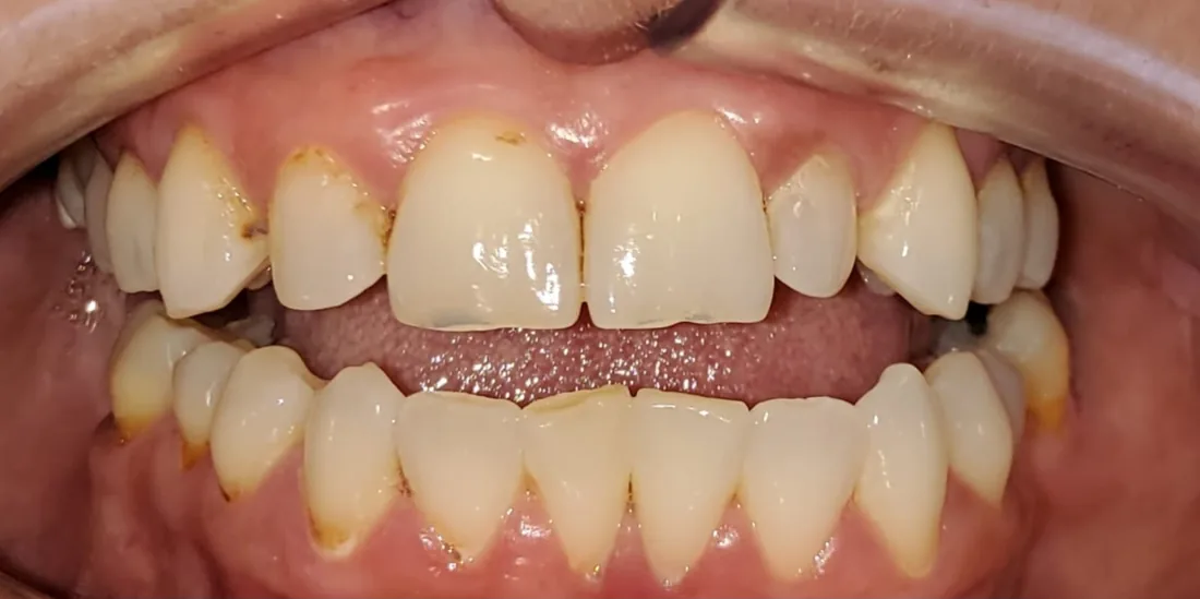 Before treatment: a patient's upper and lower front teeth