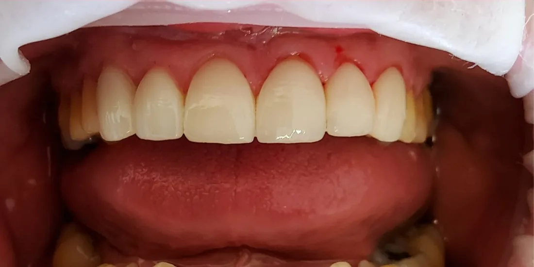 After treatment: a patient's upper front teeth