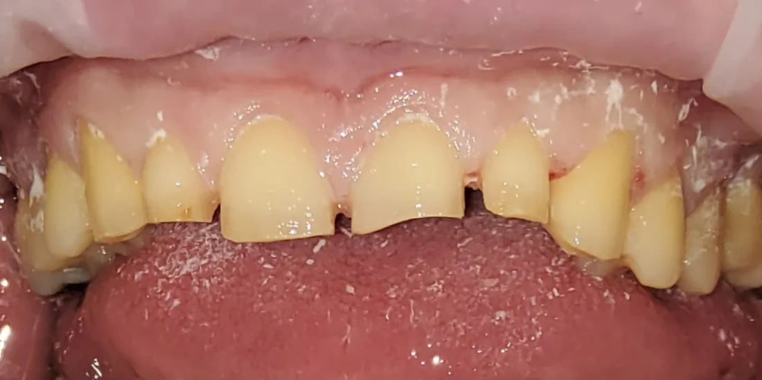 Before treatment: a patient's upper front teeth