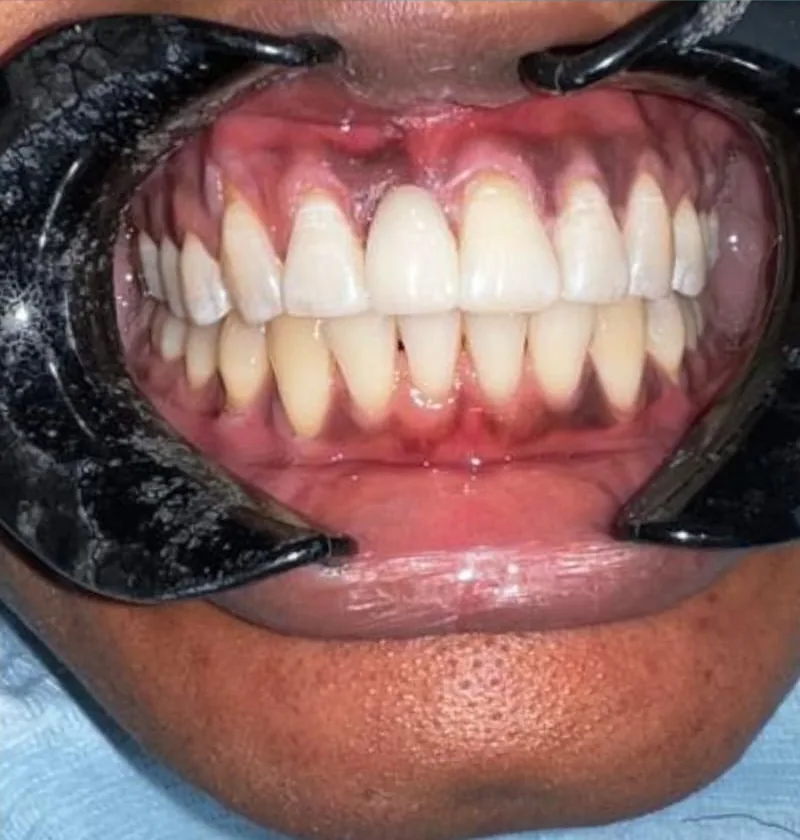 After treatment: a patient's upper and lower teeth with the lips held back