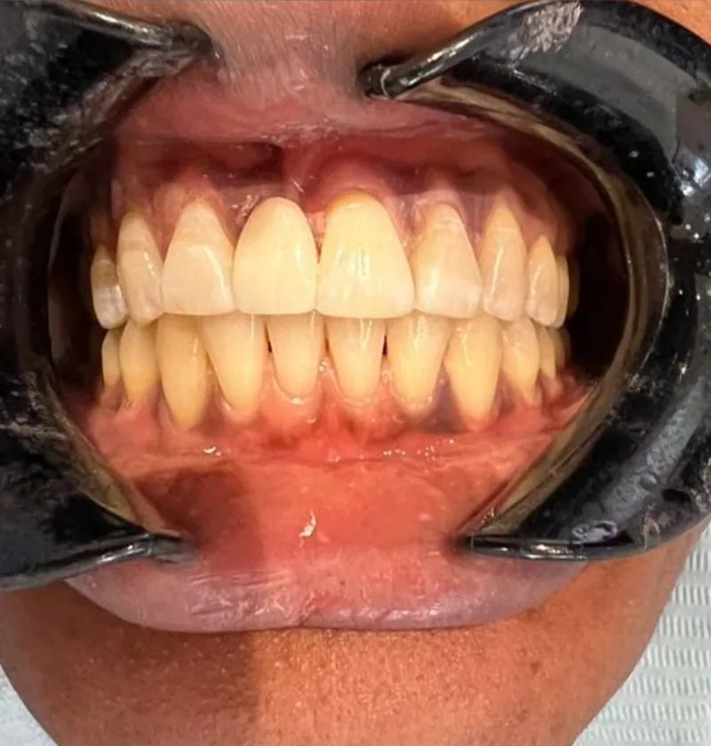 Before treatment: a patient's upper and lower teeth with the lips held back