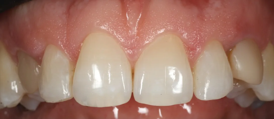 After treatment: the side view of a patient's upper and lower teeth