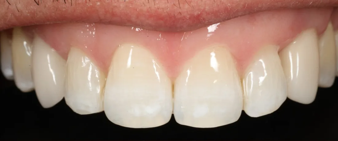 Before treatment: the side view of a patient's upper and lower teeth