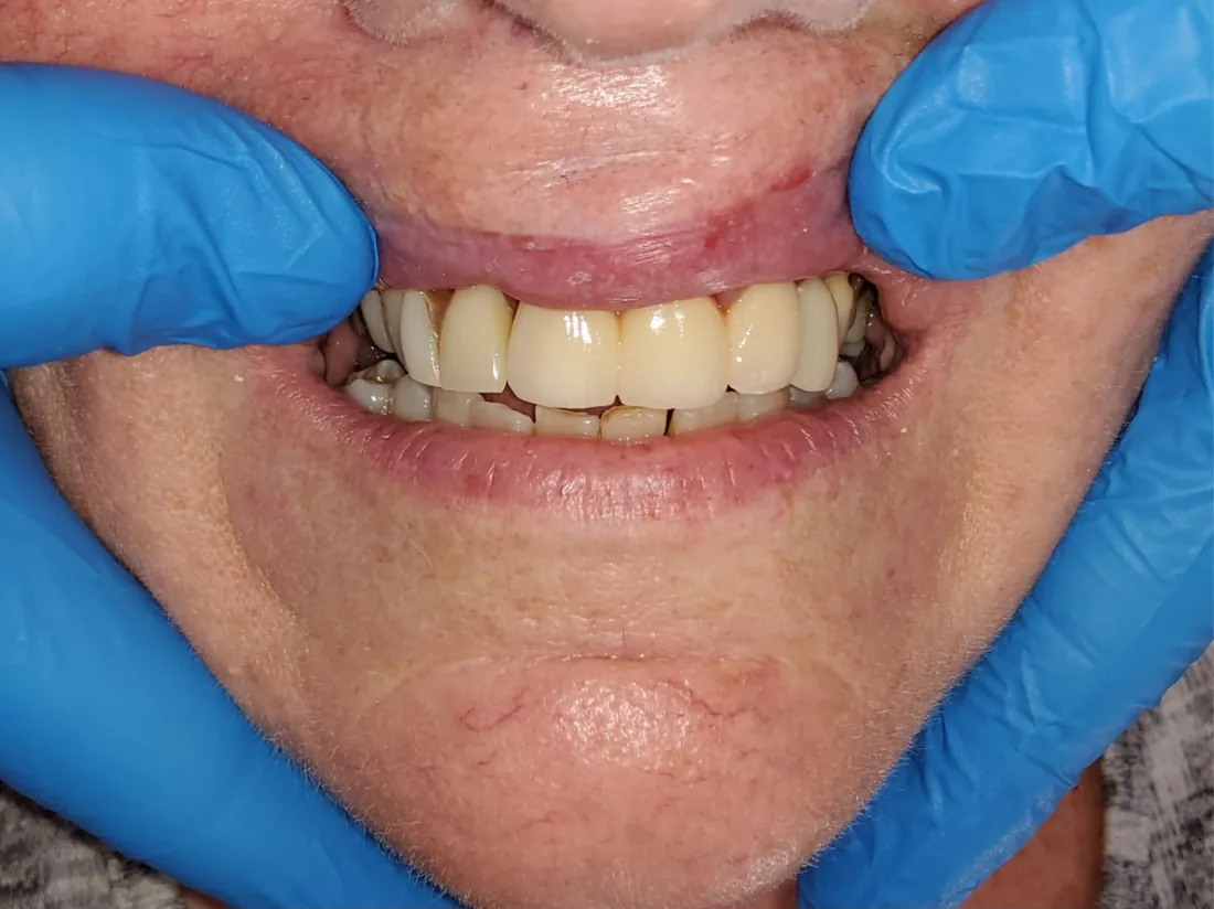 After treatment: a patient's lower front teeth