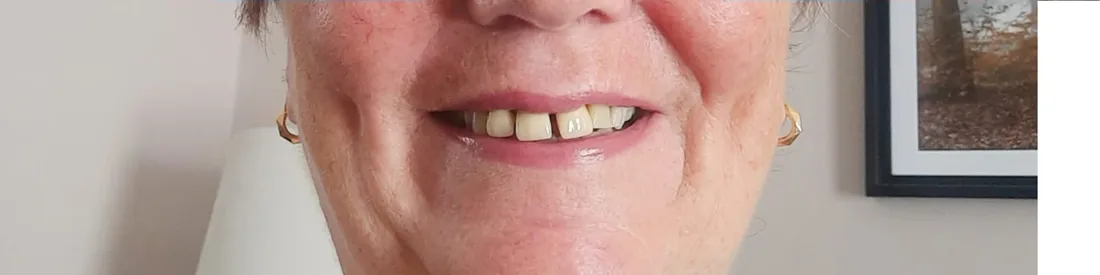 Before treatment: a patient's lower front teeth