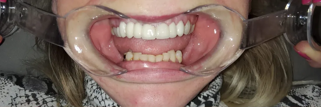 After treatment: a patient's upper and lower teeth with the lips held back