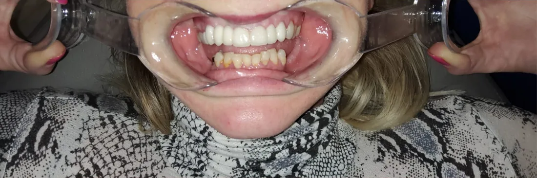 Before treatment: a patient's upper and lower teeth with the lips held back