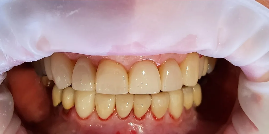 After treatment: a patient's upper and lower front teeth