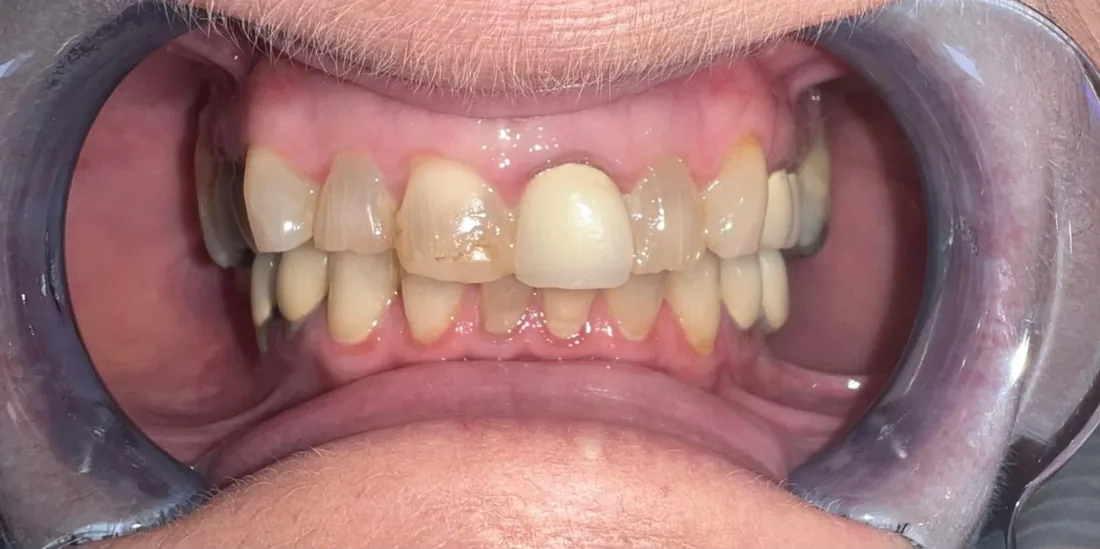 Before treatment: a patient's upper and lower front teeth