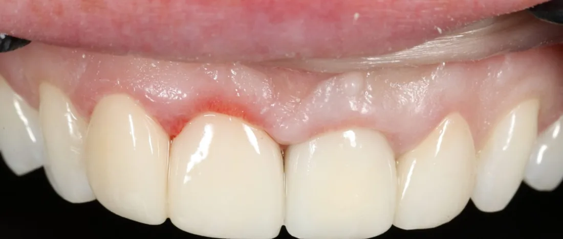 After treatment: a close-up of the side of a patient's upper teeth