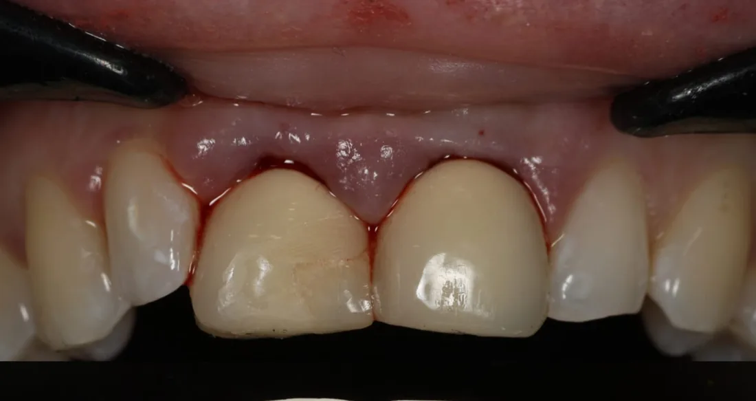 Before treatment: a close-up of the side of a patient's upper teeth