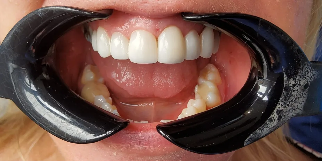 After treatment: a patient's upper and lower front teeth