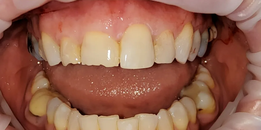 Before treatment: a patient's upper and lower front teeth